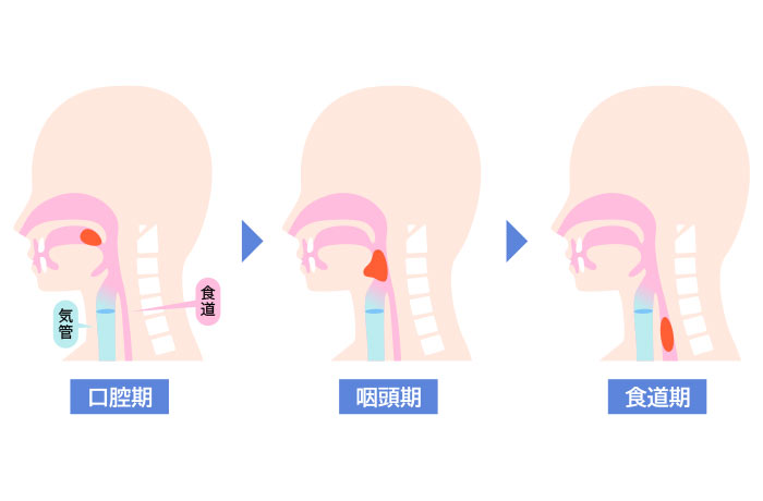 嚥下を説明するイラスト、口腔期のイラストには食道、気管・・・と文字で補足説明を加えている。次いで、咽頭期、食道期・・・説明している3つのイラスト。