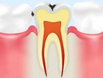 歯の表面の虫歯
