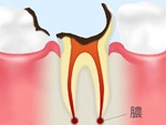歯の根の虫歯